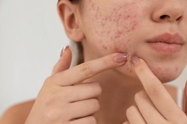 Không nên tự nặn mụn viêm vì dễ nhiễm trùng và để lại sẹo