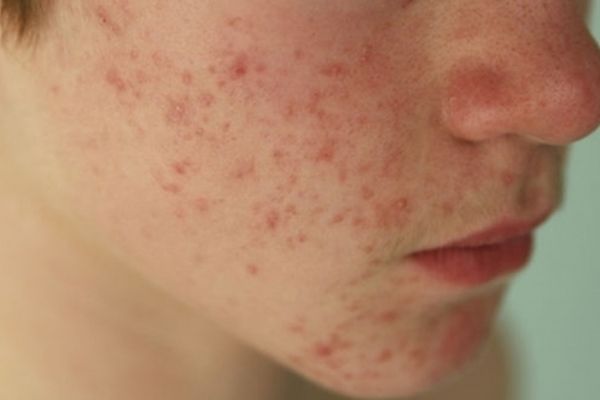 Mụn viêm nhẹ có thể tự hết, nhưng dạng nặng cần điều trị sớm