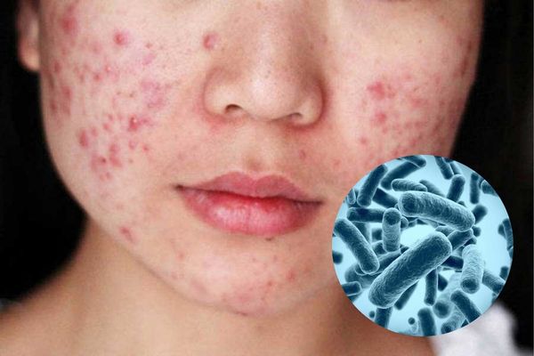 Vi khuẩn C. acnes là nguyên nhân chính gây viêm nang lông