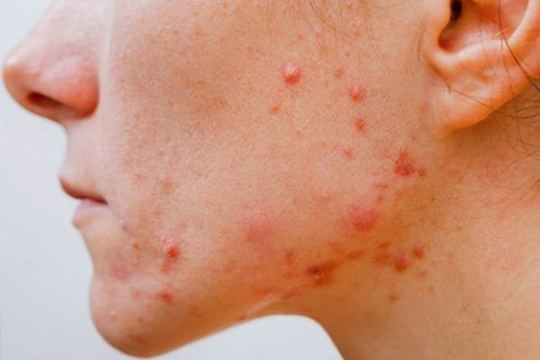 Mụn viêm đỏ là giai đoạn đầu với nốt sưng đỏ, chưa có mủ