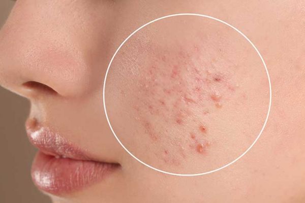 Mụn viêm là tình trạng viêm da do tắc nghẽn và vi khuẩn gây ra