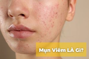 Mụn viêm là gì