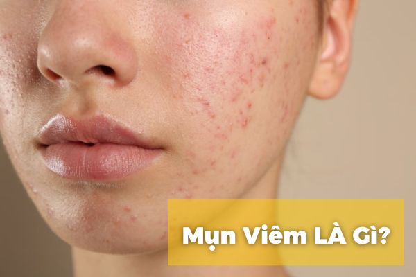 Mụn viêm là gì