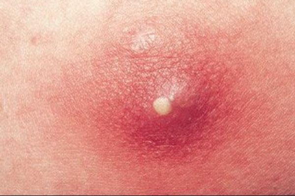 Mụn viêm mủ là giai đoạn nặng với đầu mủ trắng hoặc vàng