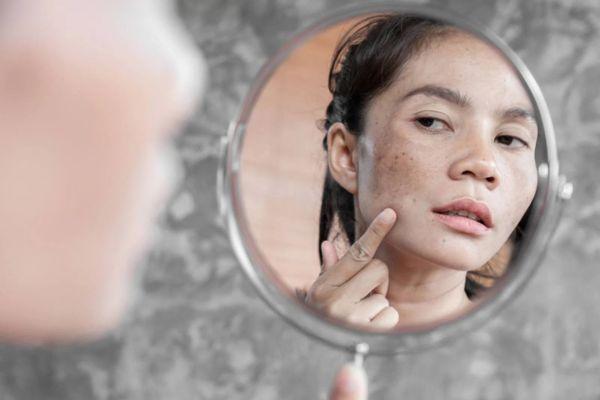 Nhận biết nám bằng những dấu hiệu cụ thể nào?