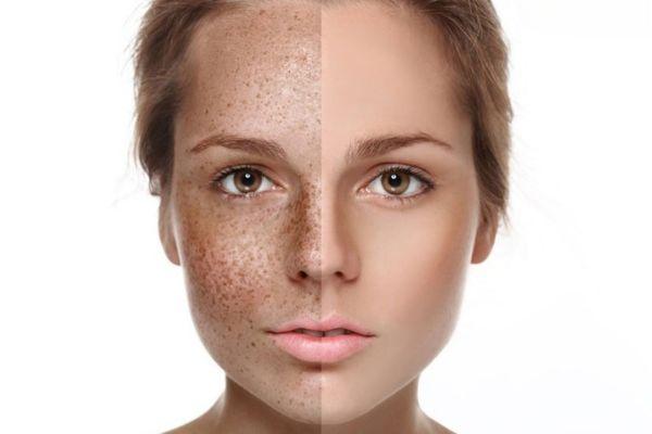 Phác đồ điều trị nám da tại Citrine Derma Clinic