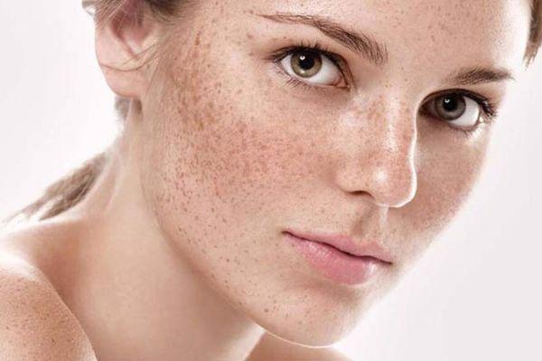 Nám Da Là Gì? Cách Nhận Biết Và Giải Quyết Triệt Để Nhất
