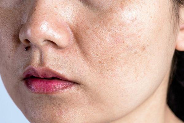 Hình ảnh nám nội tiết ngoài đời thật
