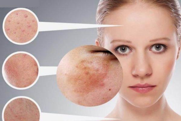 Nguyên nhân khiến cho da bị nám nội tiết là gì?