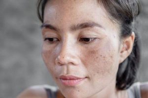 Nám Nội Tiết - Nguyên Nhân Phổ Biến Và Cách Cải Thiện