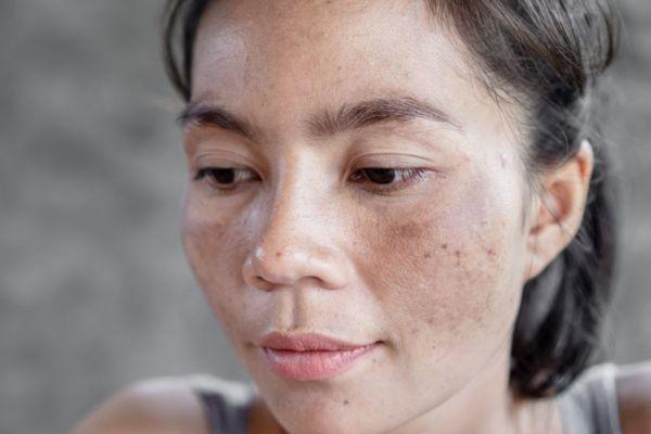 Nám Nội Tiết - Nguyên Nhân Phổ Biến Và Cách Cải Thiện