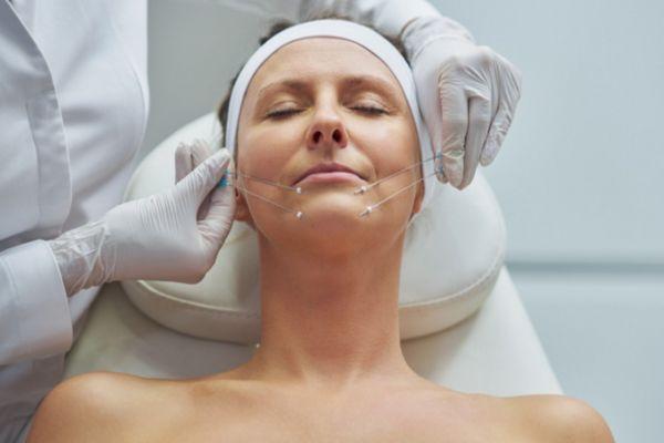 Nâng cơ bằng chỉ sinh học giúp nâng da nhanh và cải thiện chảy xệ