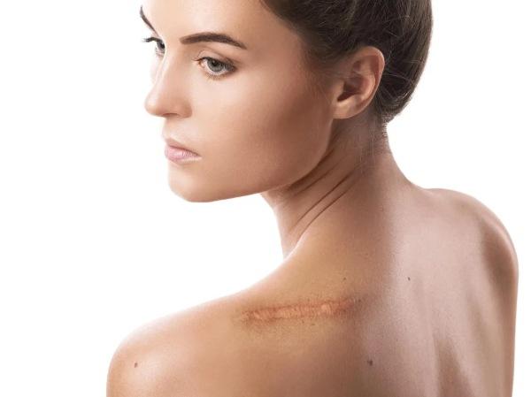 Nhóm thực phẩm cần hạn chế để tránh bị sẹo lồi