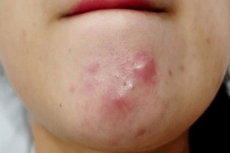 Nguyên nhân dẫn tới mụn bị chai cứng dưới da