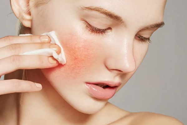 Da sần vỏ cam do lão hóa, môi trường và chăm sóc da sai cách