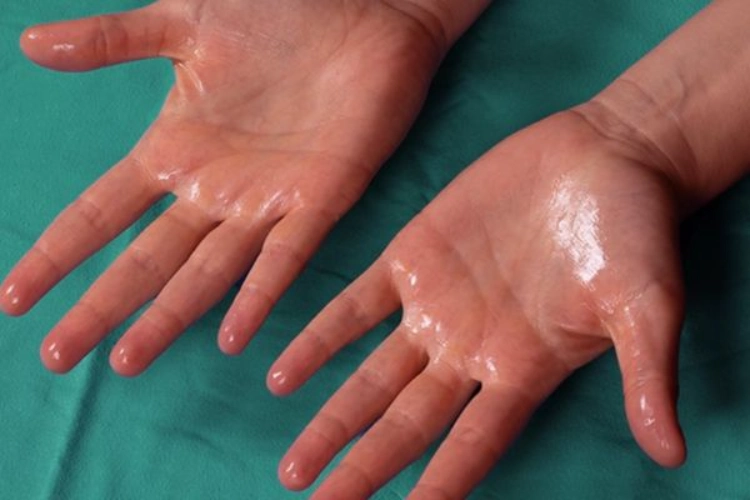 Các nguyên nhân khiến tay ra nhiều mồ hôi có thể đến từ nhiều yếu tố khác nhau