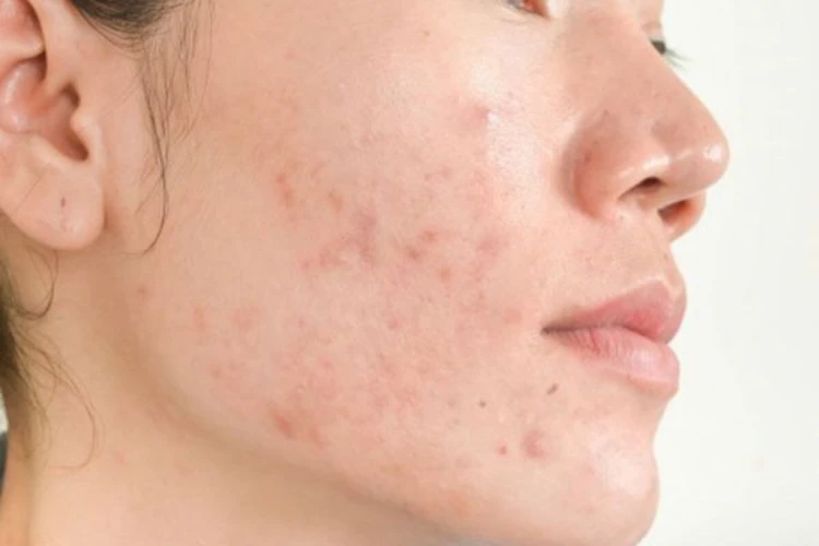 Nguyên nhân nào dẫn tới tình trạng mụn ẩn