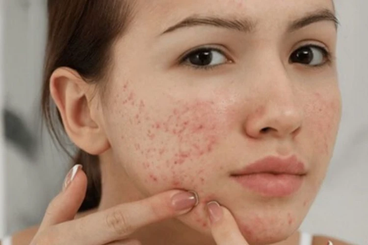 Nguyên nhân nào dẫn tới tình trạng viêm mụn?