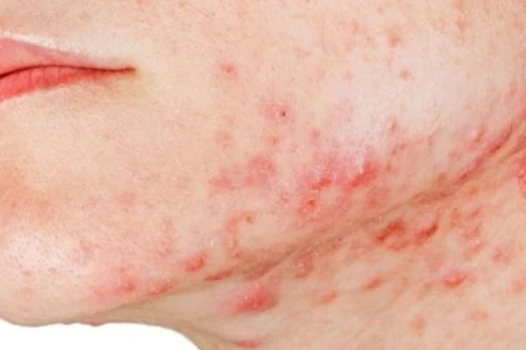 Nguyên nhân nào khiến cho mụn nội tiết nổi trên da