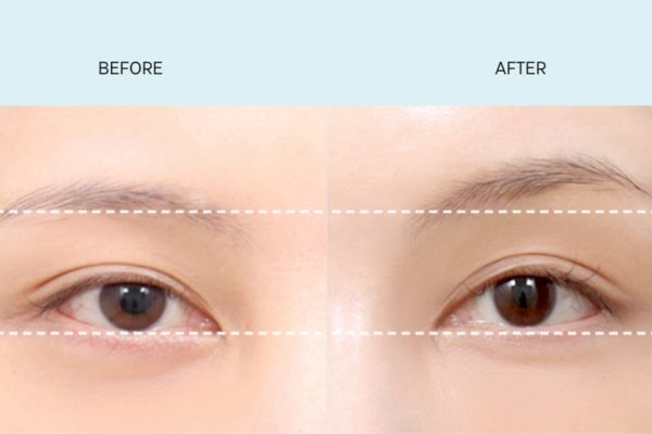Những giá trị mà dịch vụ làm đẹp nâng cung mày đem lại
