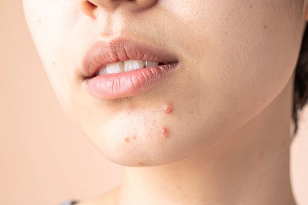 Giai đoạn phát triển của mụn bọc dưới da