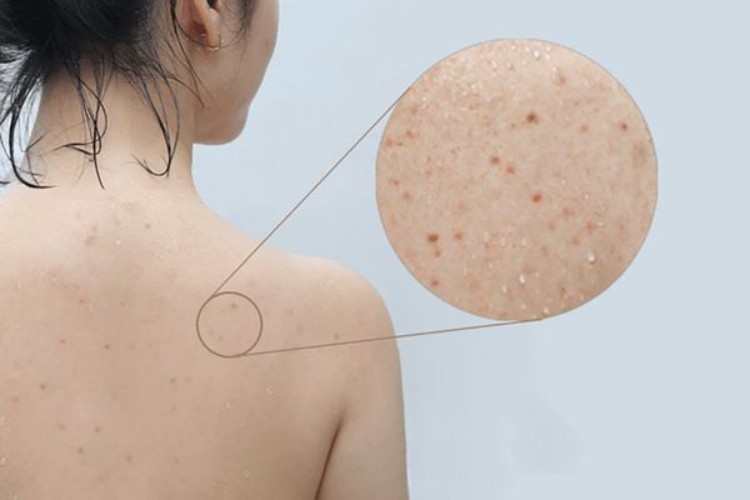 Những loại mụn lưng cơ bản cần nắm