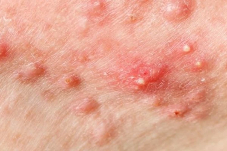 Những loại mụn thường gặp nhất cần nằm lòng