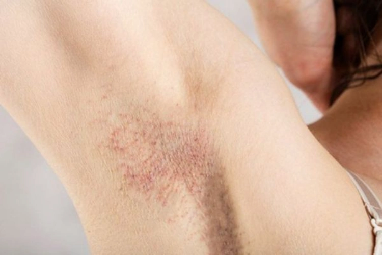Không tiêm Botox khi vùng nách đang viêm nhiễm hoặc có tổn thương