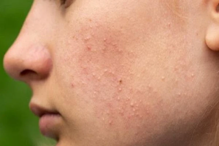 Những nguyên tắc phải tuân thủ khi điều trị mụn ẩn