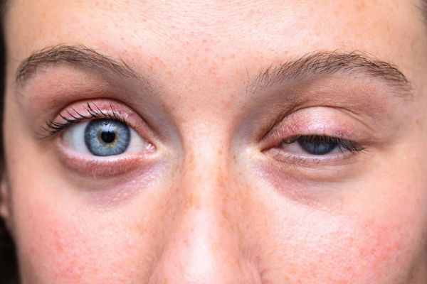 Tác dụng phụ của botox chủ yếu do tiêm sai kỹ thuật hoặc sai liều