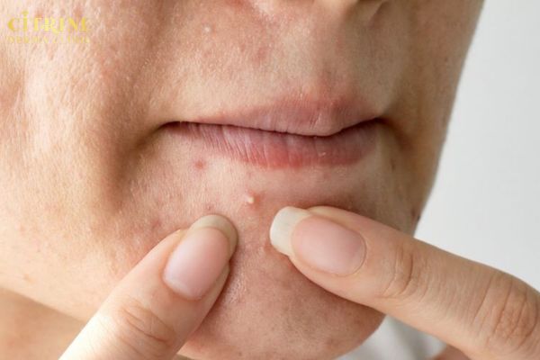 Những sai lầm khiến mụn ở cằm ngày càng nặng hơn