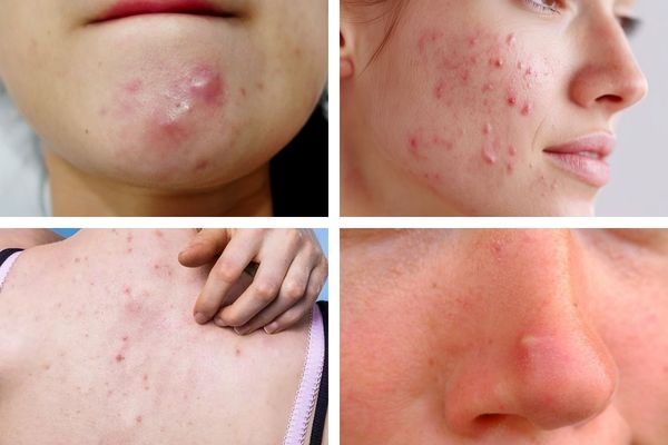 Các vị trí thường gặp của mụn bọc như cằm, mũi, lưng