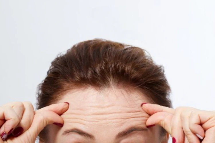 Mức độ nếp nhăn ban đầu ảnh hưởng đến hiệu quả botox