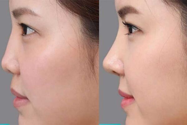 Filler mũi phù hợp với mũi thấp nhẹ, cấu trúc ổn định, không lệch vẹo