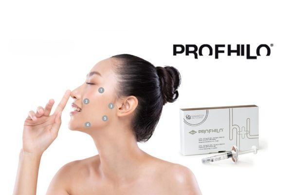 Kỹ thuật BAP Profhilo tối ưu lan tỏa HA chỉ với 5 điểm tiêm mỗi bên