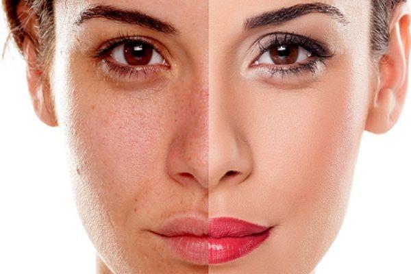 Profhilo phù hợp người muốn trẻ hóa da tự nhiên không thay đổi đường nét