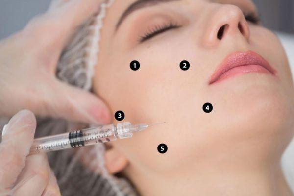 Profhilo là gì? Công dụng và kỹ thuật tiêm BAP chuẩn Ý