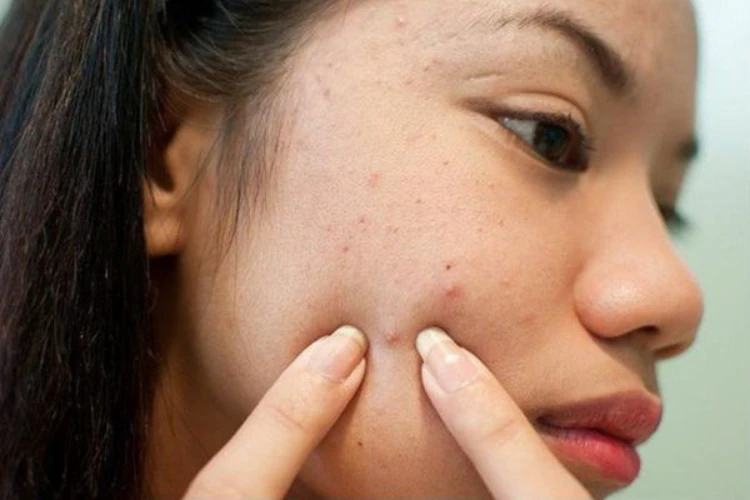 Quy trình nặn mụn đúng chuẩn y khoa cần nằm lòng