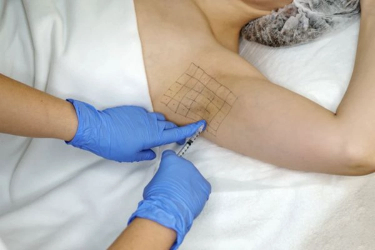 Tiêm Botox mồ hôi nách cần thực hiện đúng quy trình y khoa
