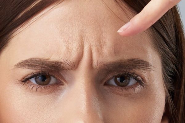 Hạn chế nhăn trán, nheo mắt để tránh làm giảm hiệu quả botox