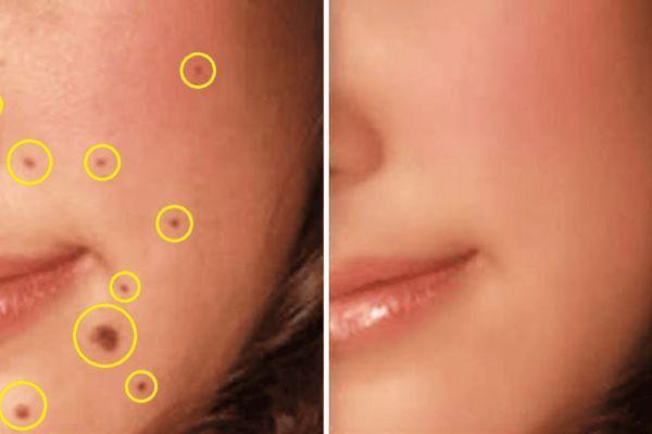 Sẹo do tẩy nốt ruồi có thực sự tự khỏi không?