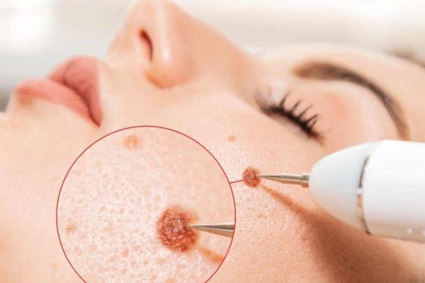 Điều trị sẹo tẩy nốt ruồi bằng cách tự nhiên thế nào?
