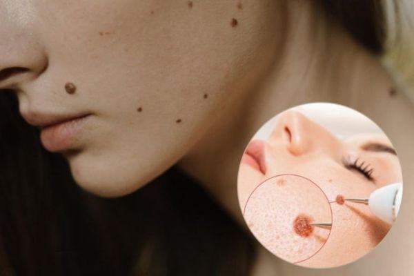 Hướng dẫn xử lý sẹo chuẩn y khoa chi tiết