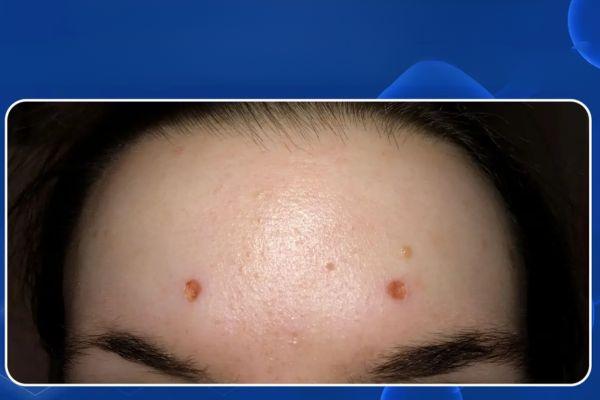 Lưu ý gì khi điều trị sẹo sau tẩy nốt ruồi?