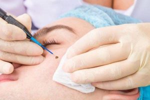 Sẹo Do Tẩy Nốt Ruồi Có Hết Không? Cách Xử Lý Hiệu Quả