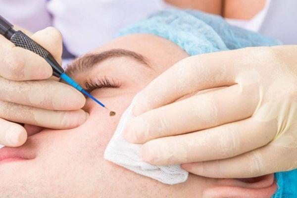 Sẹo Do Tẩy Nốt Ruồi Có Hết Không? Cách Xử Lý Hiệu Quả