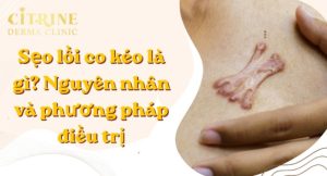 sẹo lồi co kéo là gì