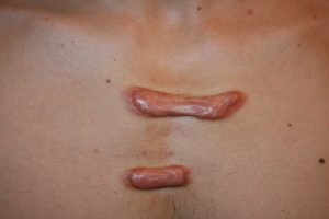 Sẹo Lồi Ở Ngực Có Chữa Được Không? Tổng Hợp Các Cách Trị Sẹo Lồi Hiệu Quả