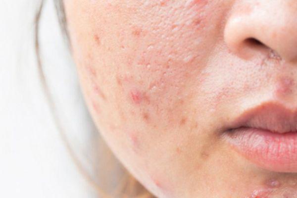 Tìm hiểu chi tiết về sẹo lõm hình thành do mụn