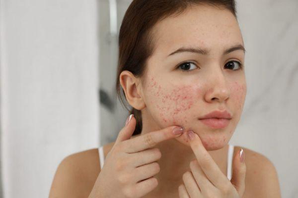 Liệu sẹo lõm có thực sự có thể tự đầy không?